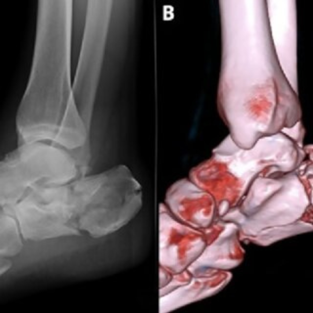 What Does a Lacerated Foot Tendon Look Like on MRI Scan?